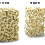 骨質疏鬆：悄悄來襲的隱形敵人