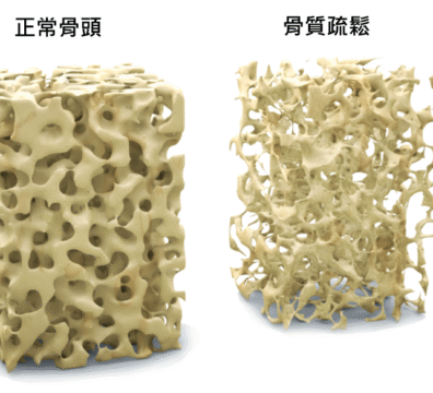 正常骨頭與骨質疏鬆骨頭的對比圖,顯示骨密度的差異與結構變化。