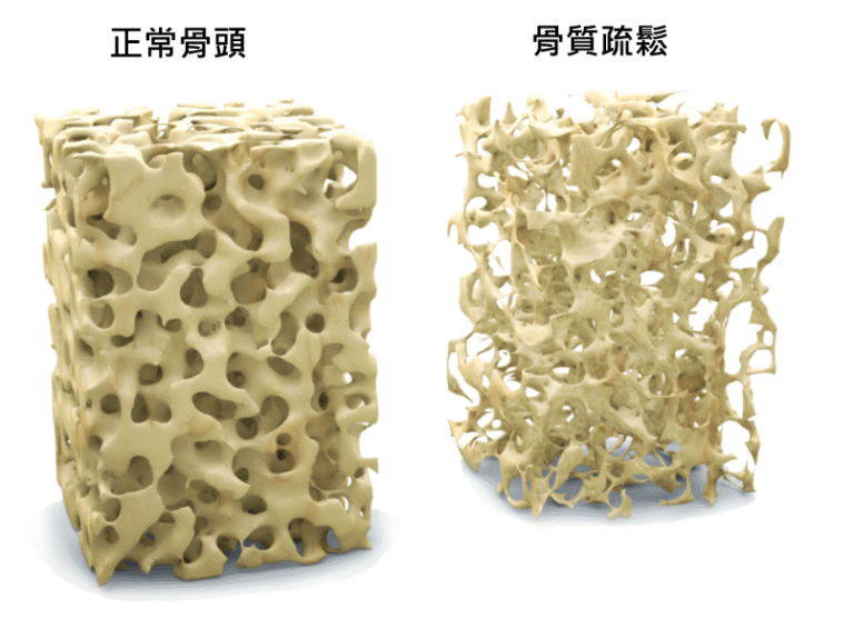 正常骨頭與骨質疏鬆骨頭的對比圖，顯示骨密度的差異與結構變化。