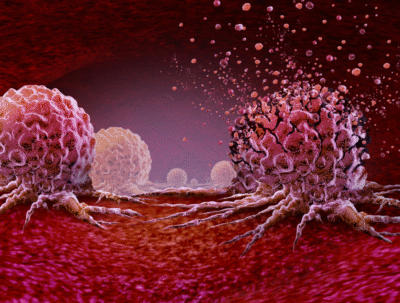 113年國人死因統計出爐，癌症高居不下