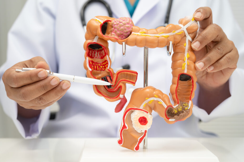 醫師以大腸模型說明結腸、直腸與大腸癌病灶位置